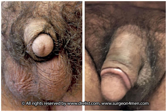 Buried Penis Before & After Image