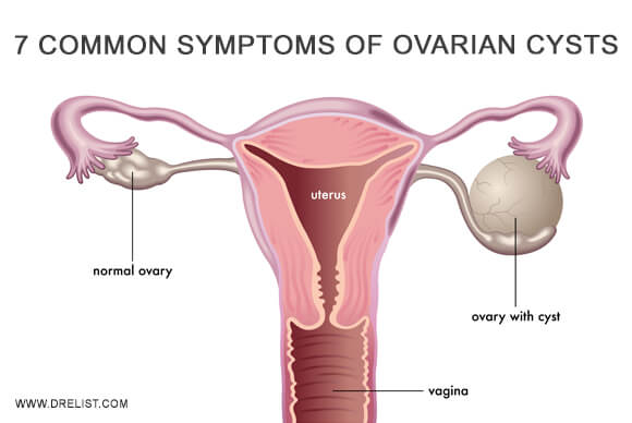 https://www.drelist.com/assets/img/blog/7-common-symptoms-ovarian-cysts.jpg