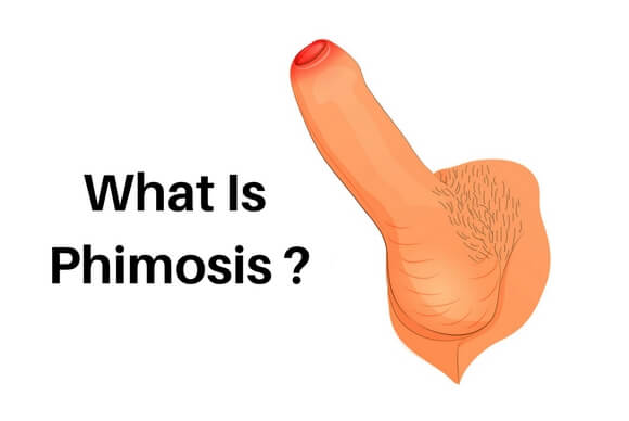 Phimosis Treatment without surgery, Causes, Symptoms