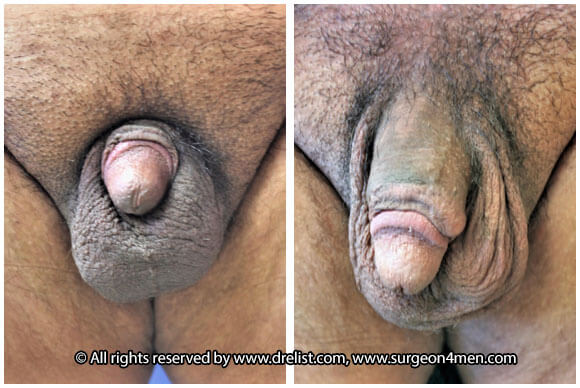 Buried Penis Before & After Image