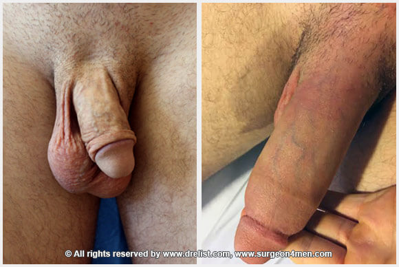 Erect Penis Before & After Image
