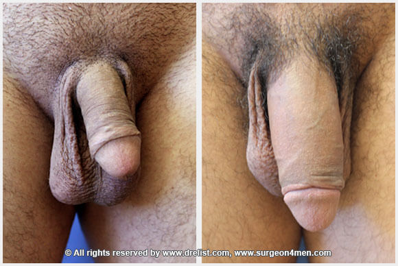 Penis Enlargement Before & After Image