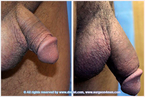 Penis Enlargement Before & After Image