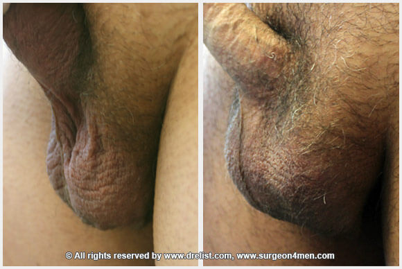 Testicular Enlargement Before & After Image